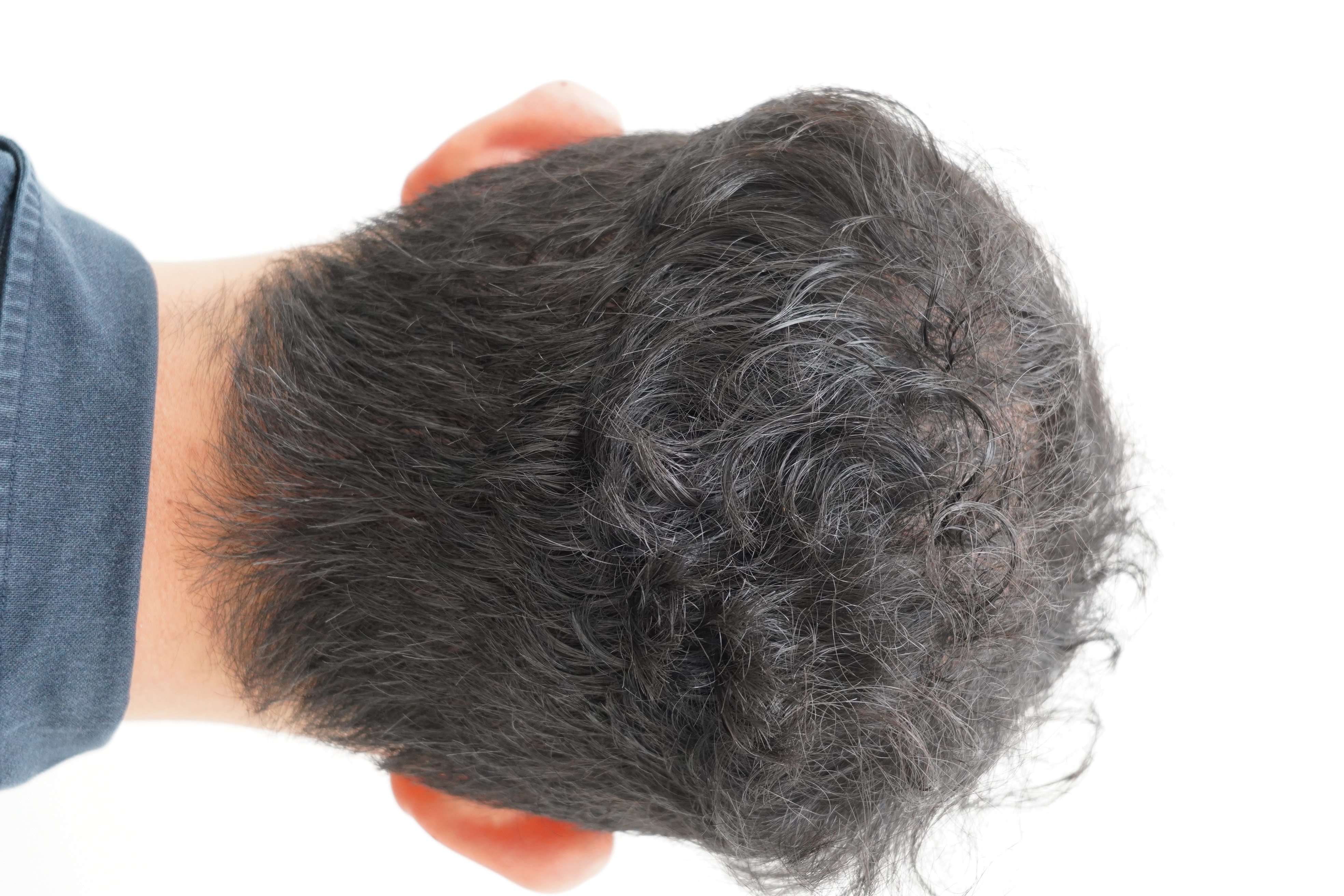 [연세모나의원] 8개월 차 경과 올려봅니다. 두피 비침 완전히 잡혔네요