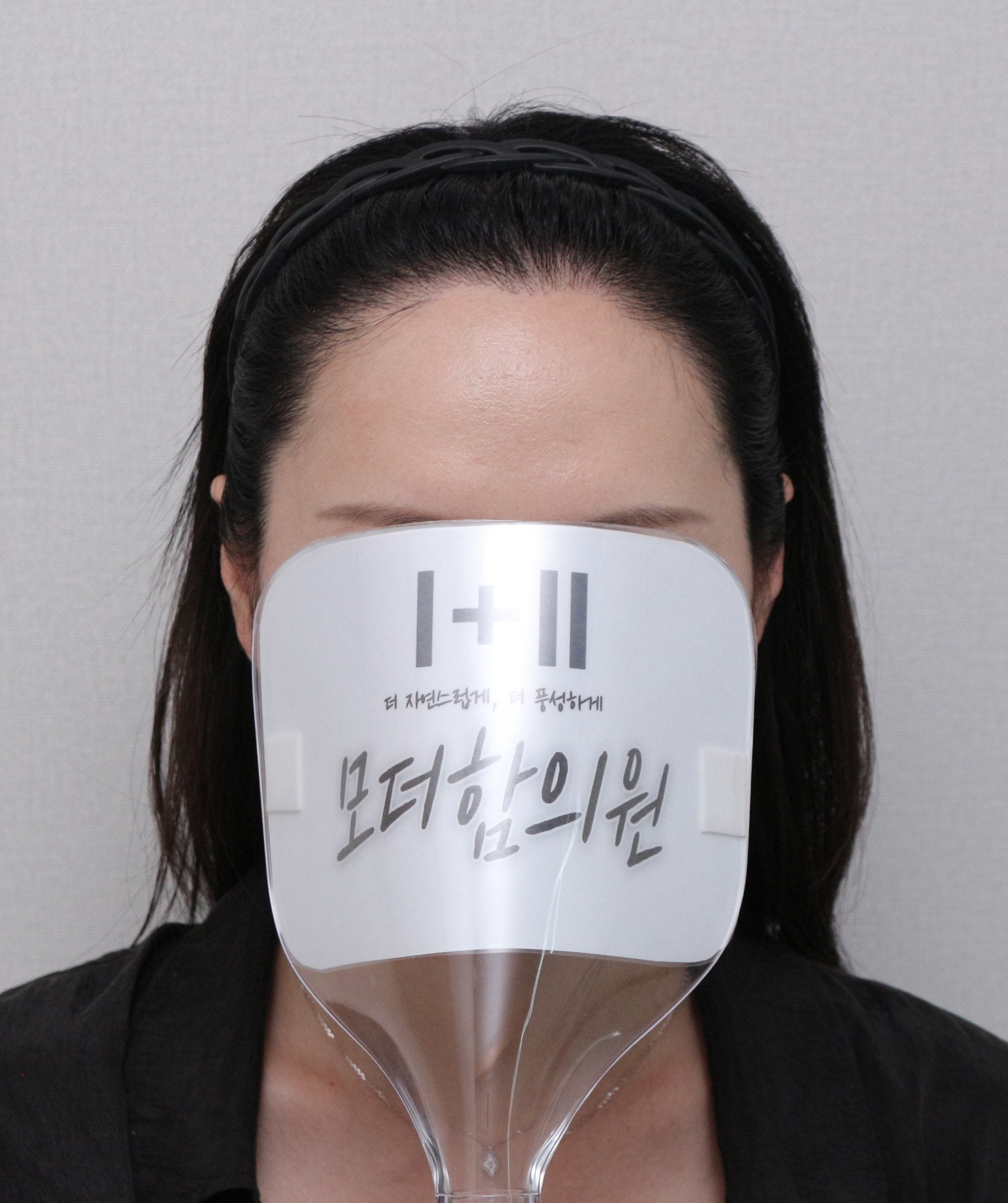 압구정 모더함 모발이식 비절개 여성헤어라인 1년 후기 (약 13개월)