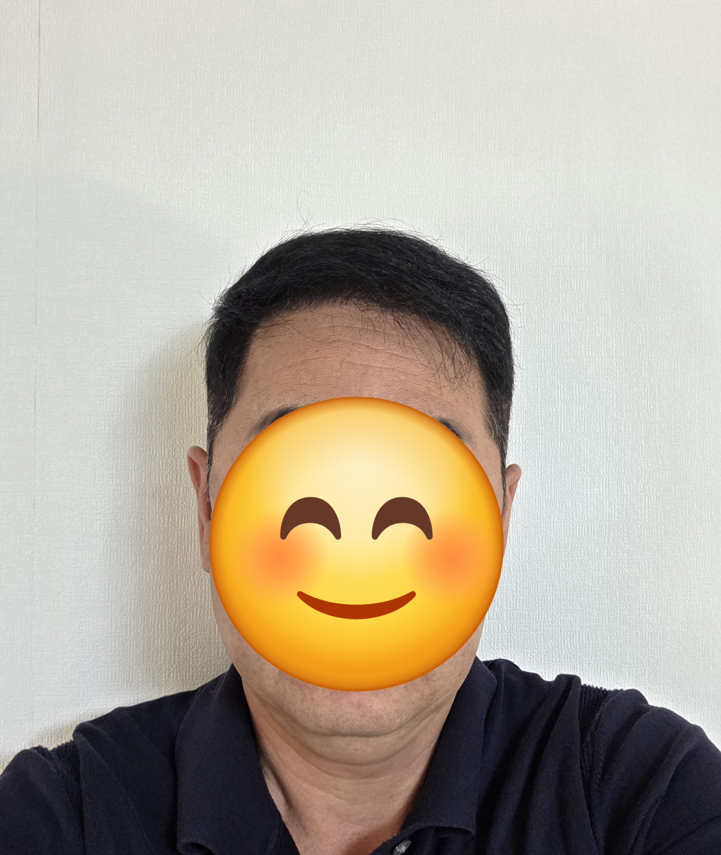 더블랙대구 모발이식 1년째
