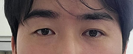 이태연수술전.jpg