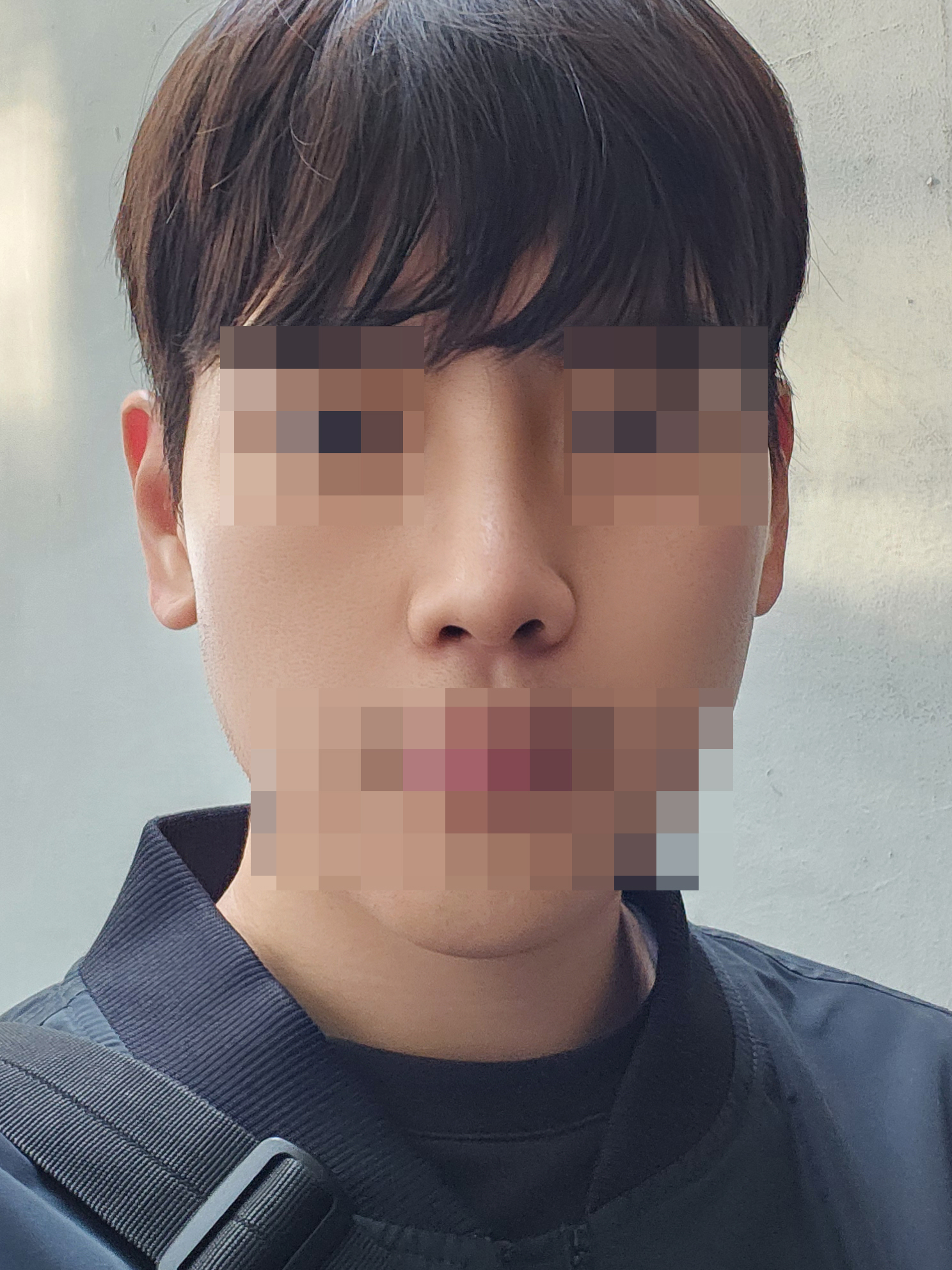 수술 후 2개월차 (2) 복사.jpg