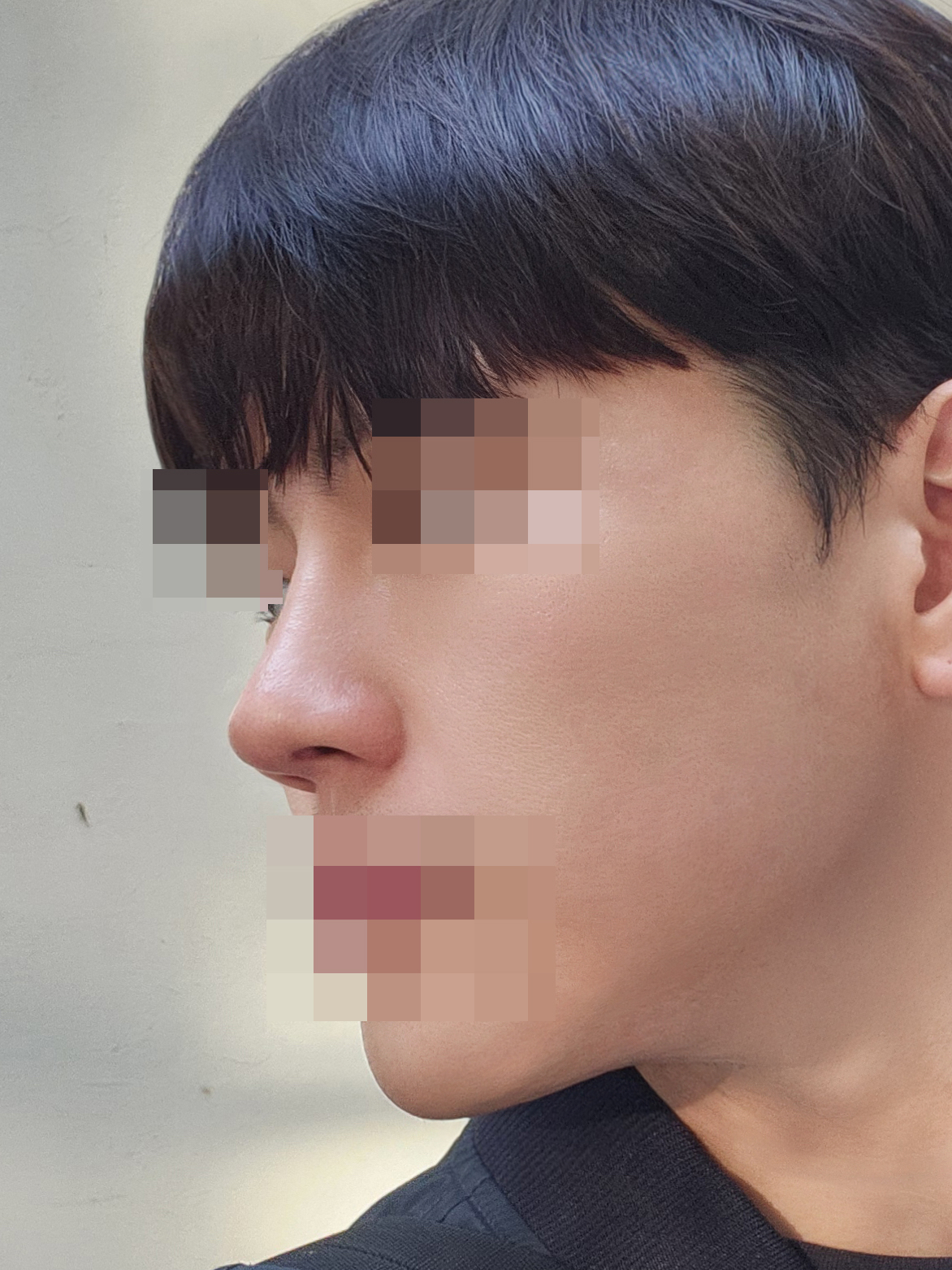 수술 후 2개월차 (3) 복사.jpg