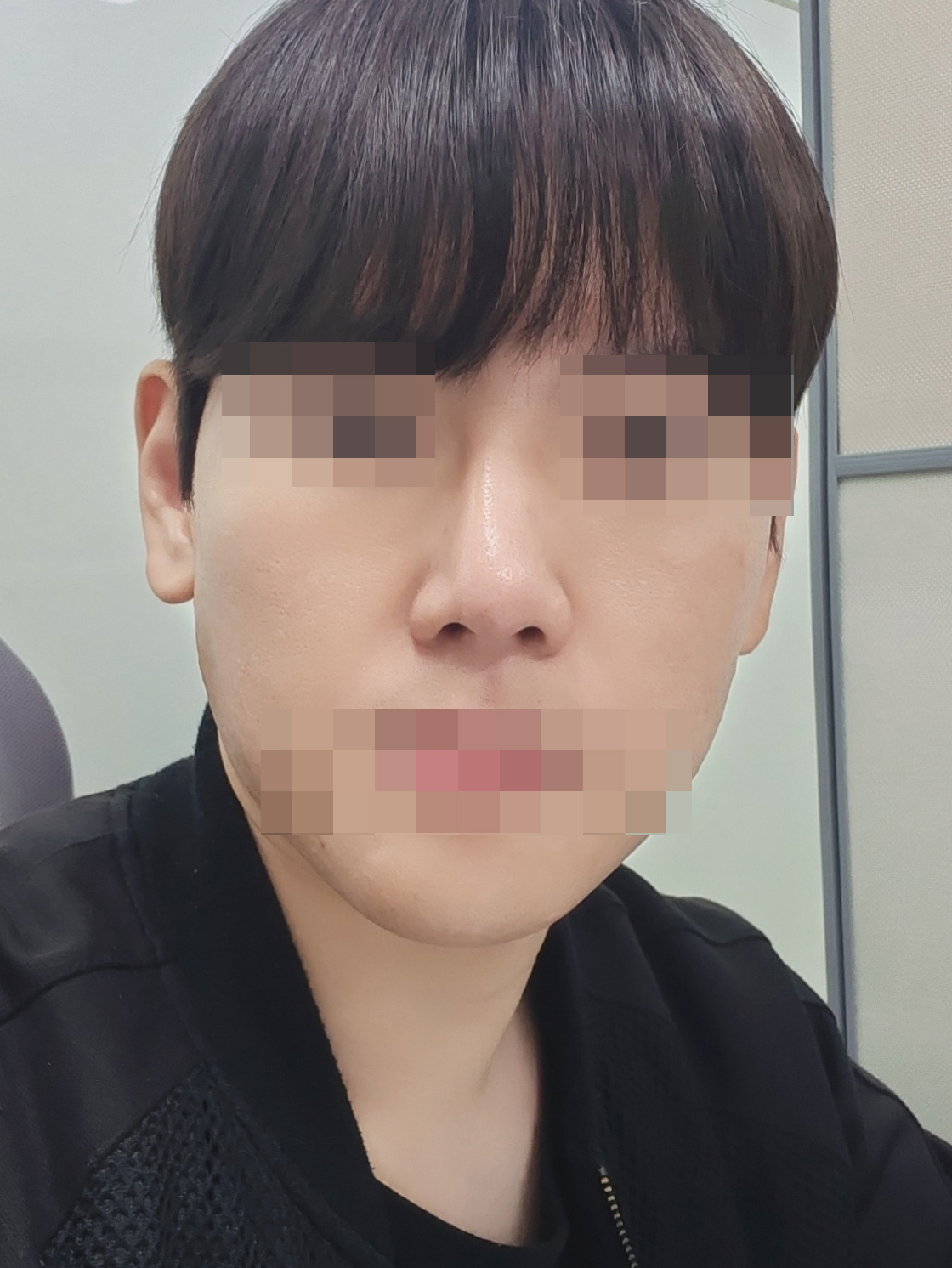 수술전 (1) 복사.jpg