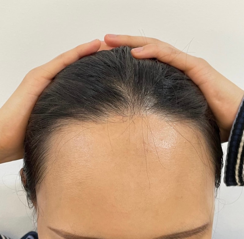 DA 整形外科 女士 发际线 毛发移植 4500 毛（当日）