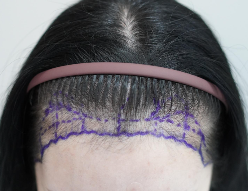 New Hair Busan Branch 2500 mother female hairline hair transplant on the 11th day (Bald in Advertising)