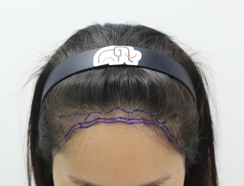 Apgujeong Mamos Hairline Diamond Slit Women's Hairline Correction Day Review (Director Seok Ji-woong)
