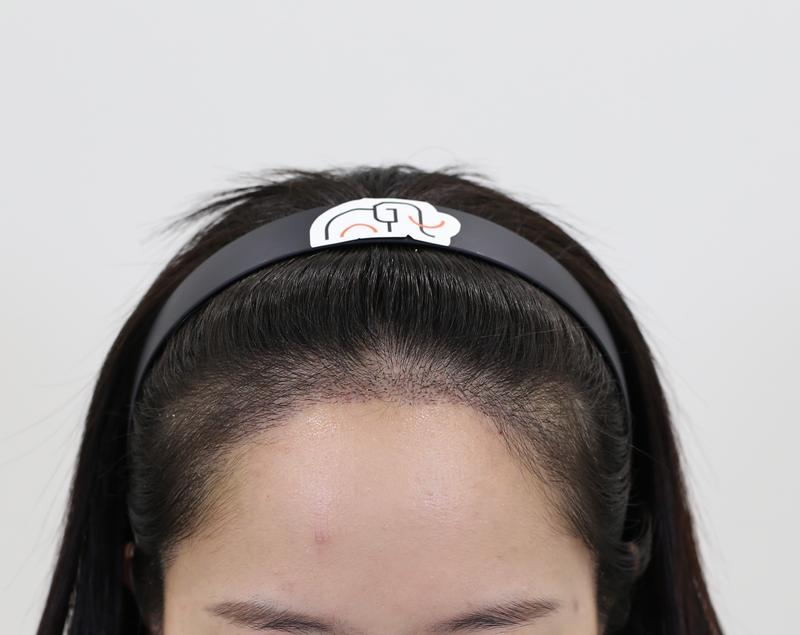 Apgujeong Mamos Hairline Diamond Slit Women's Hairline 2nd Week Review (Director Seok Ji-woong)