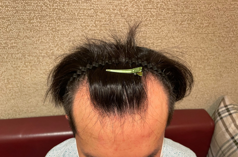 [서울점] 4000모 절개 12개월 후기