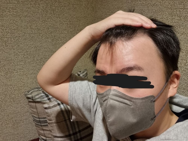 New Hair Non-Cutting 200 Hair follicle Transplantation 12 Months Late