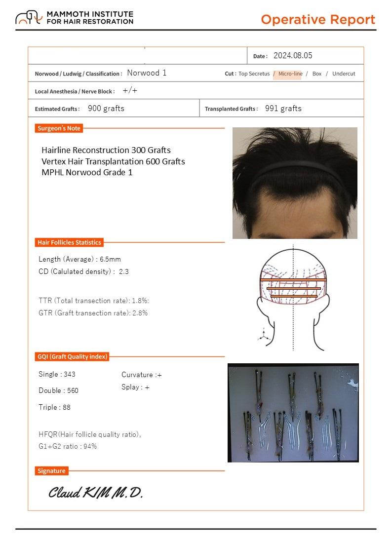 부산 비절개 줄기 세포 이식 M자+정수리 수술 후 1일차 입니다. (맘모스헤어라인의원)
