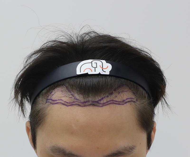 Apgujeong Mammoth Hairline Clinic M-shaped hair loss non-cut hair transplant after 2 weeks of progress check