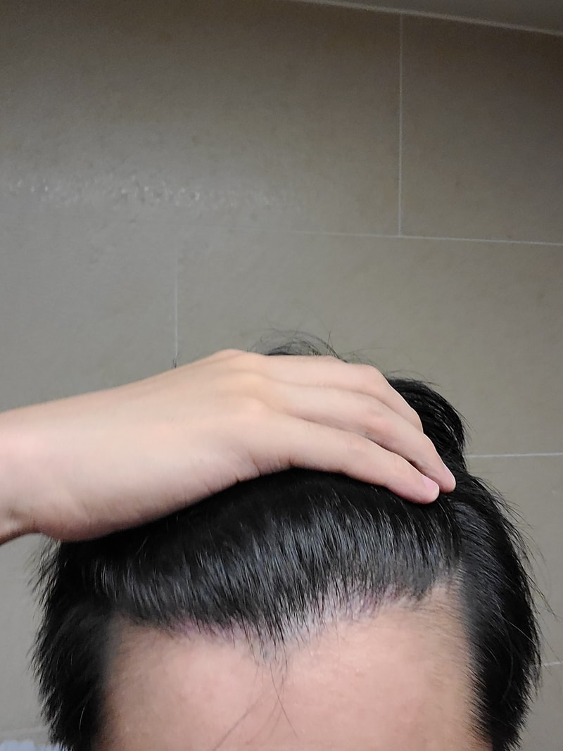 [New Hair Seoul Branch] A review of 1,600 hair follicles for non-cut hair transplantation
