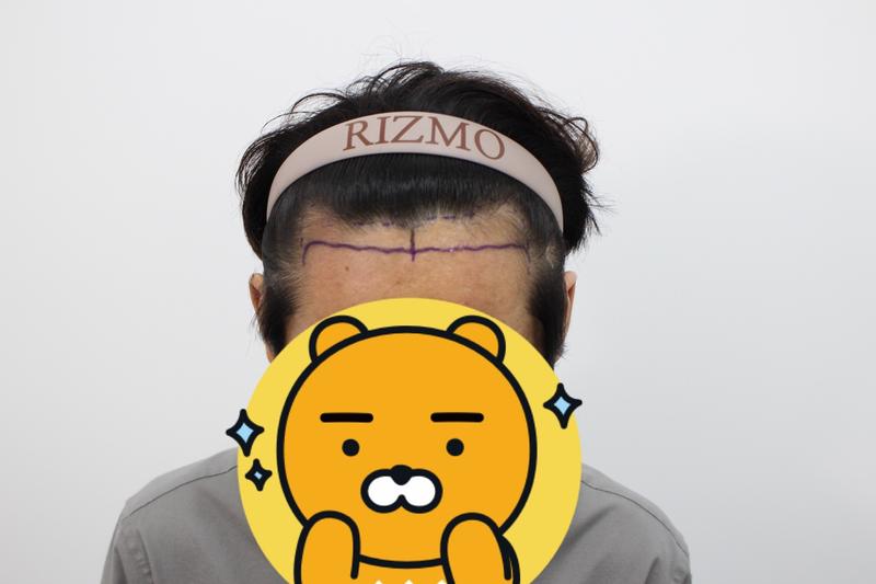 수술  1년차 후기입니다.