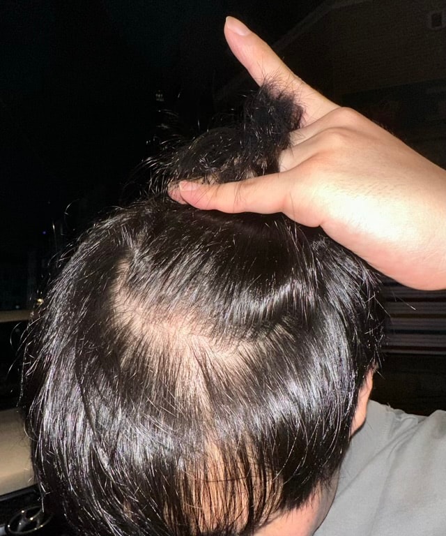 [New Hair] Non-cut 3000 Mo Surgery + Day 1