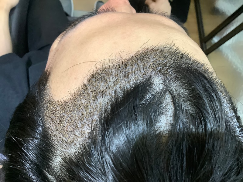 Before and after day 10 of hair transplantation at the clinic