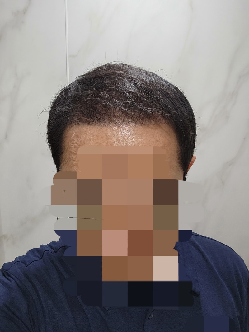 Dana整形外科无削发/非切开/额头部位为主/2300毛囊/大量移植 4 个月经过