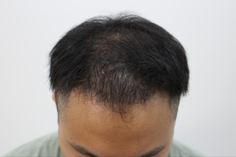 This is the last review of the first year of the 4,000-mo hair transplant