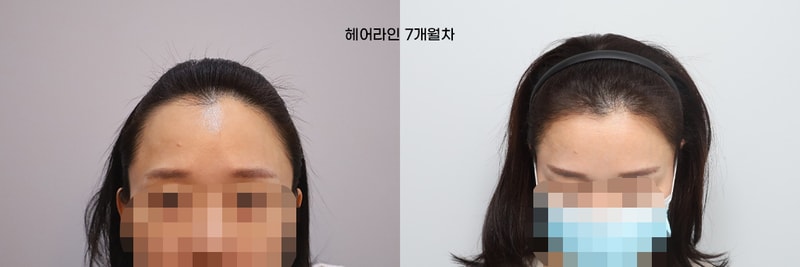 女性ヘアラインの7ヶ月目のレビューです。