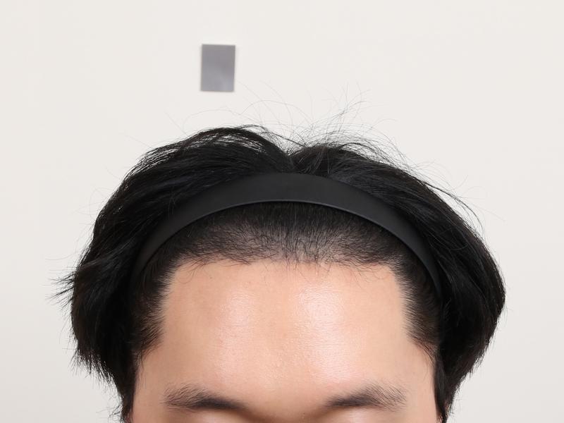 Busan Mammoth M-shaped hair transplant after 5 months
