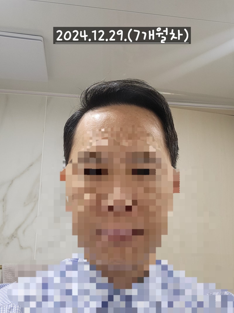 Dana整形外科无削发/非切开/额头部位为主/2300毛囊/大量移植 7 个月经过