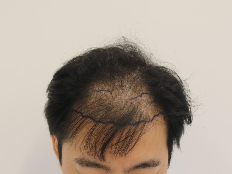 Busan Mammoth M-shaped hair transplant 10 months later, review