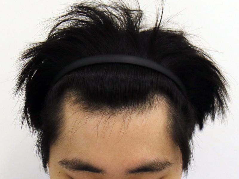 부산 맘모스 M자, 정수리 모발이식 4개월 경과