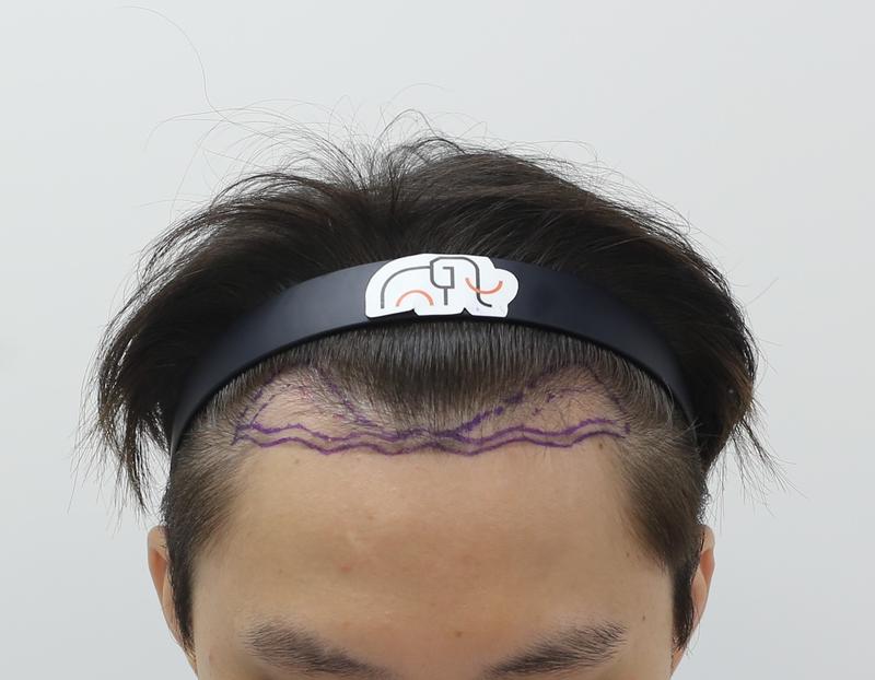 Apgujeong Mammoth Hairline Clinic M-shaped hair loss non-cut hair transplant after 4 months of progress check