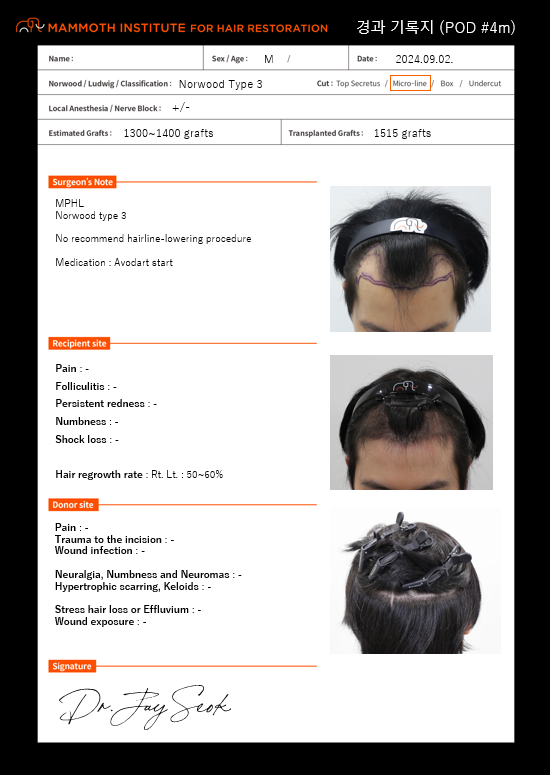 Apgujeong Mammoth Hairline Clinic M-shaped non-cut hair transplantation is in the fourth month.