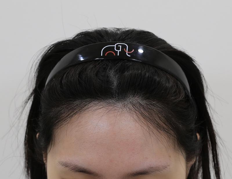 Apgujeong Mammoth No-Cut Hairline Correction Review (7 months)