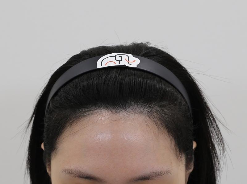 Apgujeong Mammoth No-Cut Hairline Correction Review (4 months)
