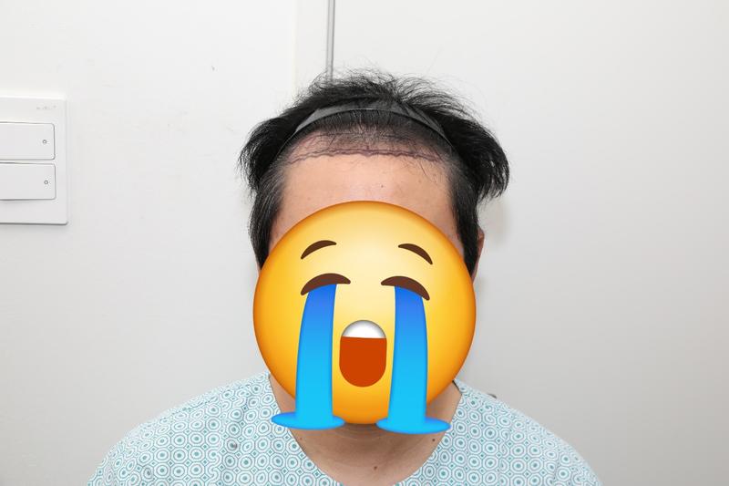 江南新发成功植发。