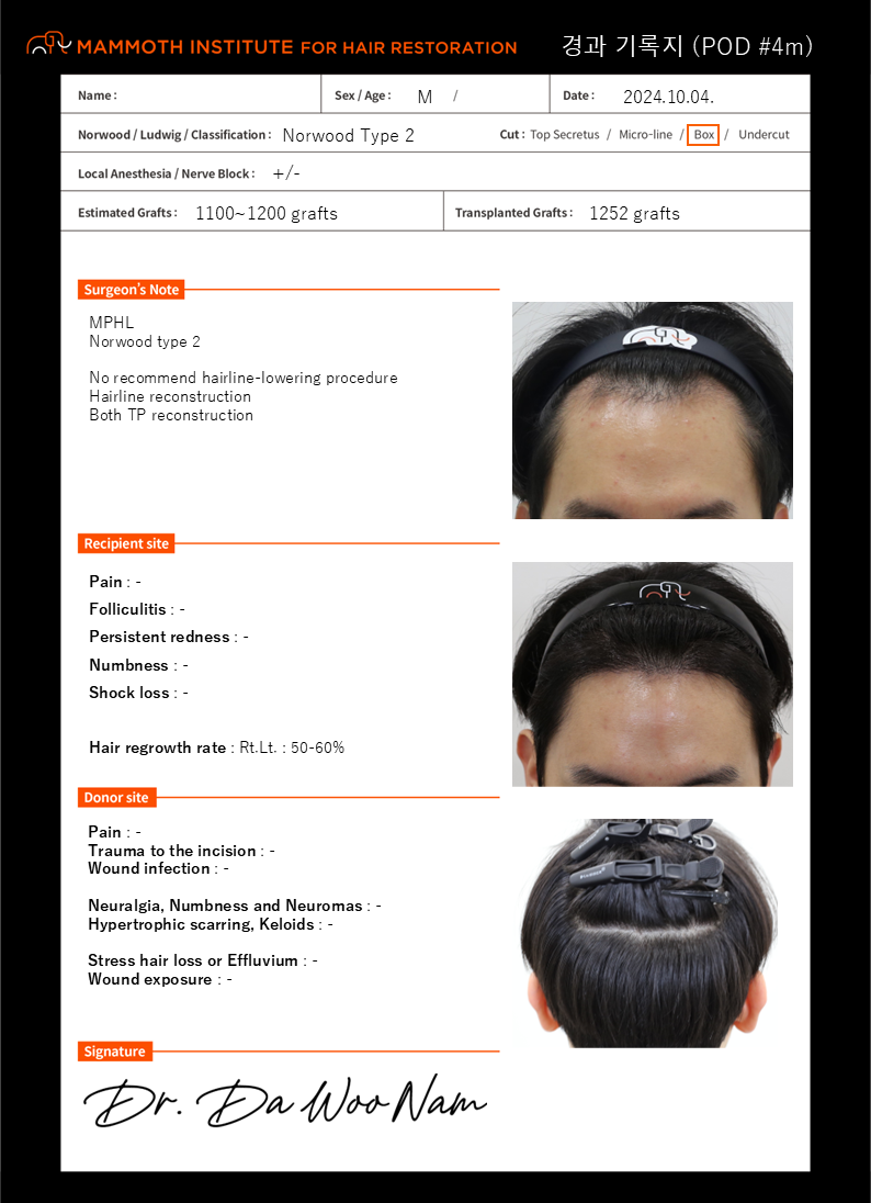 Apgujeong Mammoth Hairline Clinic M-shaped non-cut hair transplant in 4 months