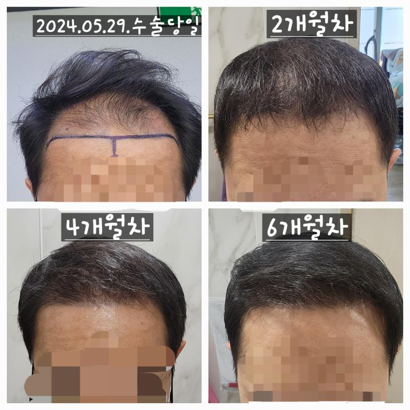 Dana整形外科无削发/非切开/额头部位为主/2300毛囊/大量移植 8 个月经过