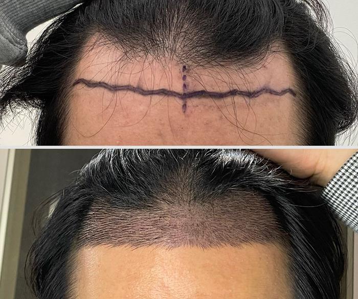 (내용, 사진 많음) 5500모 8일째까지 모발이식 궁금증 다 풀어드립니다