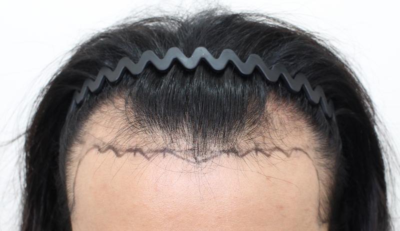 Gentleman Mopro Clinic, Male M-shaped Hair Loss, Non-Cutting (Two Block) Review