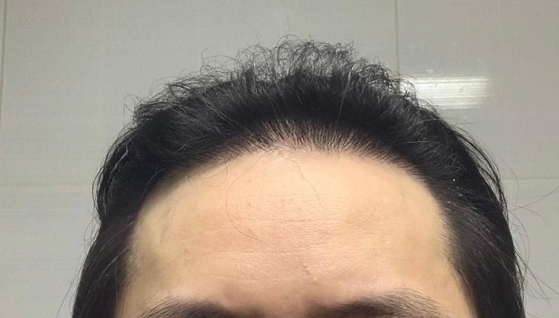 毛髪移植8ヶ月目です~~