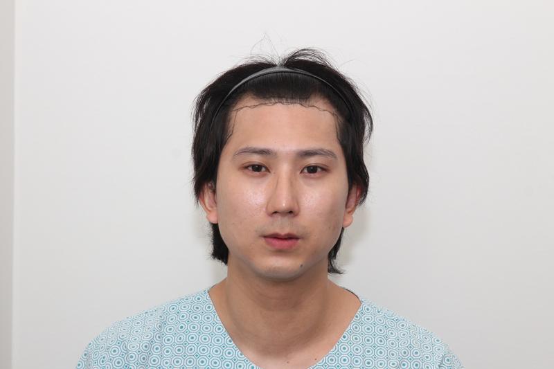 新发型首尔店切开毛发移植1900毛囊（3800毛）8个月后期。