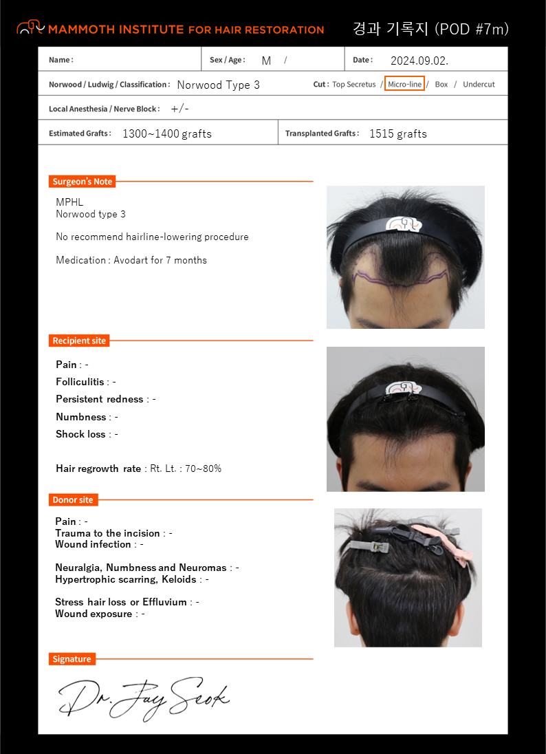 Apgujeong Mammoth Hairline Clinic M-shaped hair transplant 7 months later.