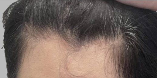4ヶ月が過ぎたヘアラインの移植経過を残してみましょう~