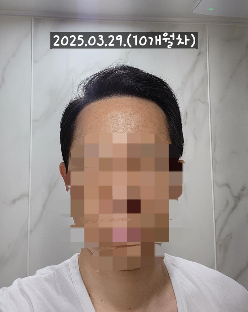 Dana整形外科无削发/非切开/额头部位为主/2300毛囊/大量移植 10 个月经过