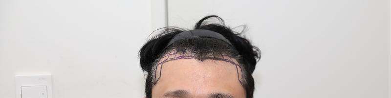 New Hair Hospital / Hair Transplantation / 1700 Hair Organs / 3 Months Late