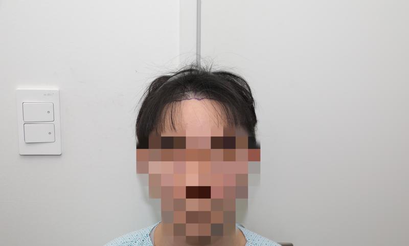 비절개 모발이식 1300모낭 밀도보강 1년차 후기