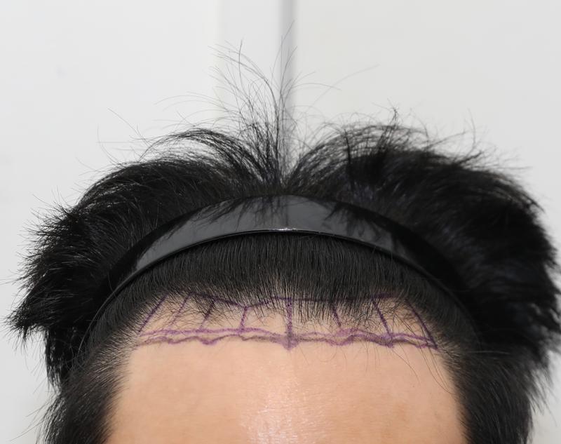 뉴헤어모발성형외과 모발이식 2000모낭 6개월 후기