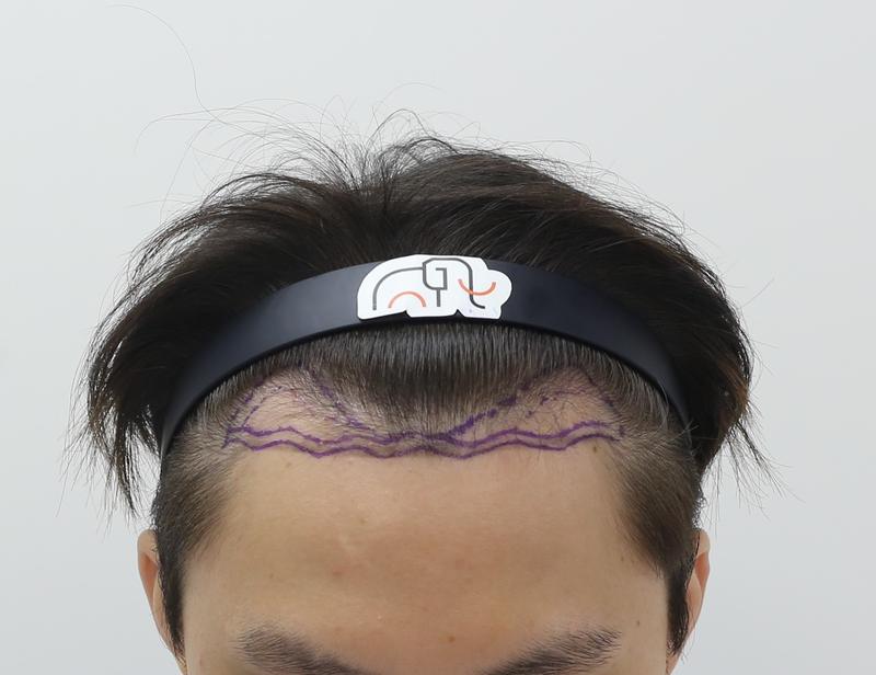 Apgujeong Mammoth Hairline Clinic M-shaped hair loss non-cut hair transplant after 8 months of progress check