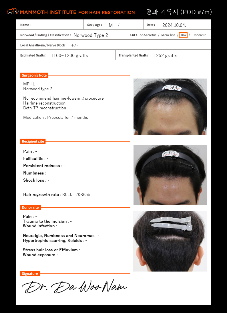 Apgujeong Mammoth Hairline Clinic M-shaped non-cut hair transplant 7 months ago