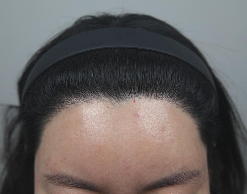 8 months of female m-shaped hair transplantation