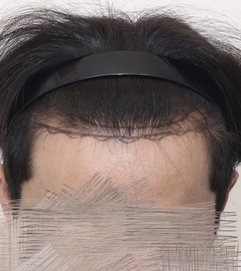 뉴헤어 강남점 비절개모발이식 900모낭 6개월차 후기