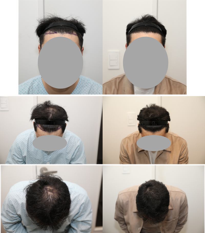 뉴헤어 서울점 절개 2000모낭 수술후기입니다.(6개월 후)