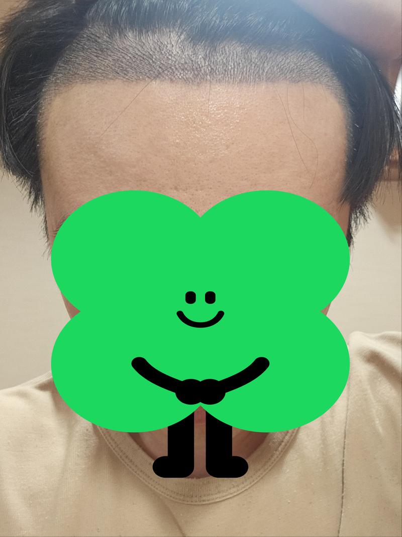 非切開一週間目の後期