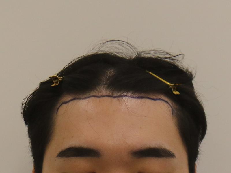 M-shape of Mammoth in Busan + 8th month review of top of head